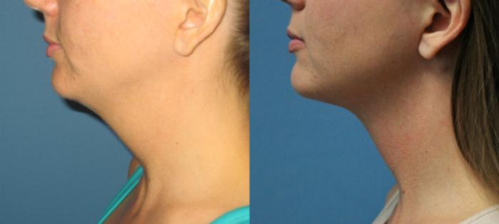 Before & After Liposuction - Neck / Precision TX Face & Neck Case 67 View #1 View in Coeur d'Alene, ID