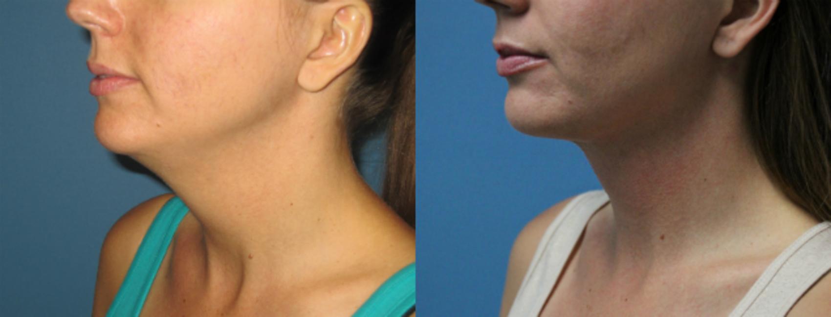 Before & After Liposuction - Neck / Precision TX Face & Neck Case 67 View #2 View in Coeur d'Alene, ID