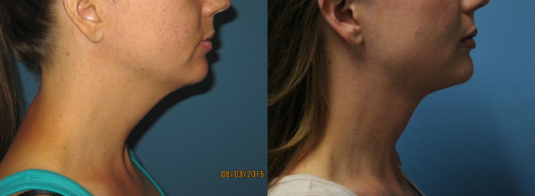 Before & After Liposuction - Neck / Precision TX Face & Neck Case 67 View #3 View in Coeur d'Alene, ID
