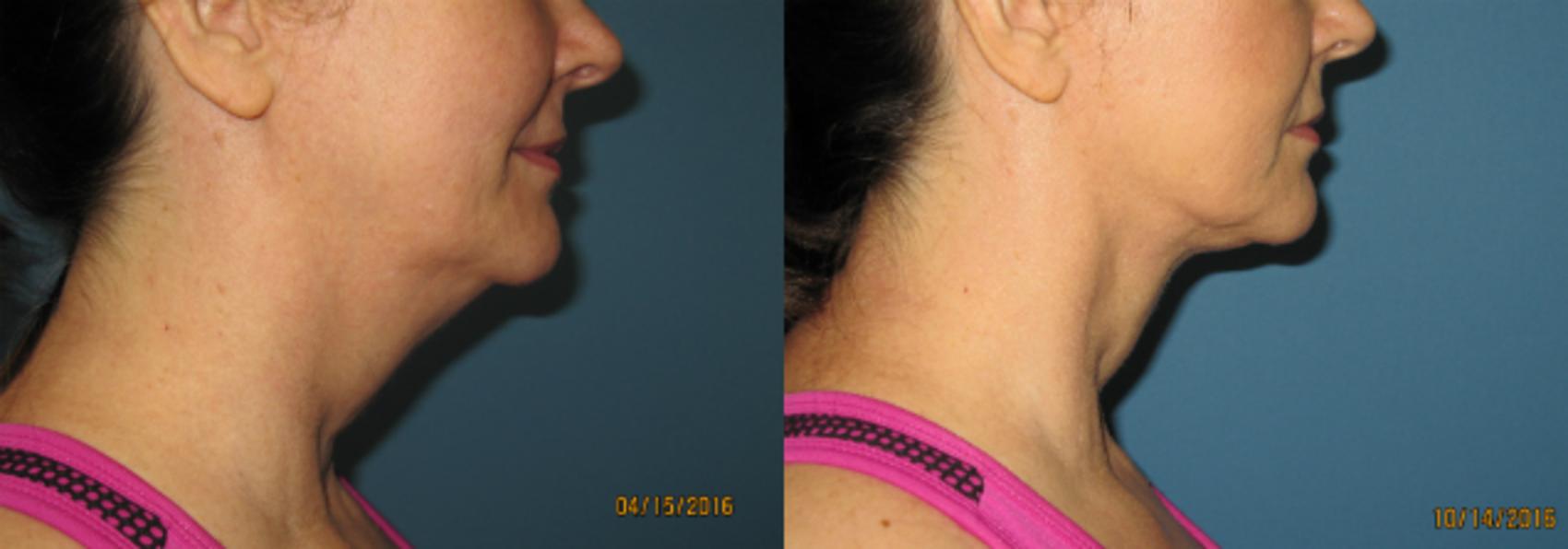 Before & After Liposuction - Neck / Precision TX Face & Neck Case 76 View #1 View in Coeur d'Alene, ID