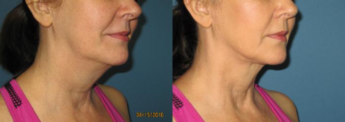 Before & After Liposuction - Neck / Precision TX Face & Neck Case 76 View #2 View in Coeur d'Alene, ID