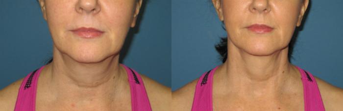 Before & After Liposuction - Neck / Precision TX Face & Neck Case 76 View #3 View in Coeur d'Alene, ID