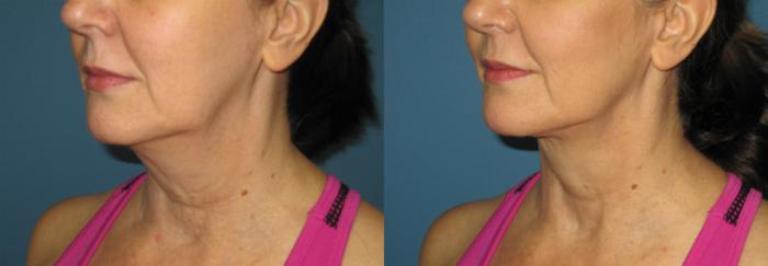 Before & After Liposuction - Neck / Precision TX Face & Neck Case 76 View #4 View in Coeur d'Alene, ID