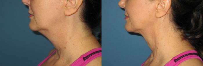 Before & After Liposuction - Neck / Precision TX Face & Neck Case 76 View #5 View in Coeur d'Alene, ID