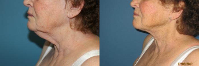 Before & After Liposuction - Neck / Precision TX Face & Neck Case 84 View #1 View in Coeur d'Alene, ID