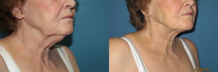 Before & After Liposuction - Neck / Precision TX Face & Neck Case 84 View #2 View in Coeur d'Alene, ID