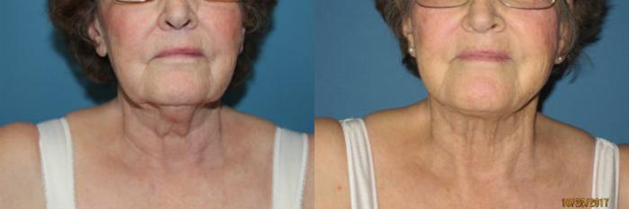 Before & After Liposuction - Neck / Precision TX Face & Neck Case 84 View #3 View in Coeur d'Alene, ID