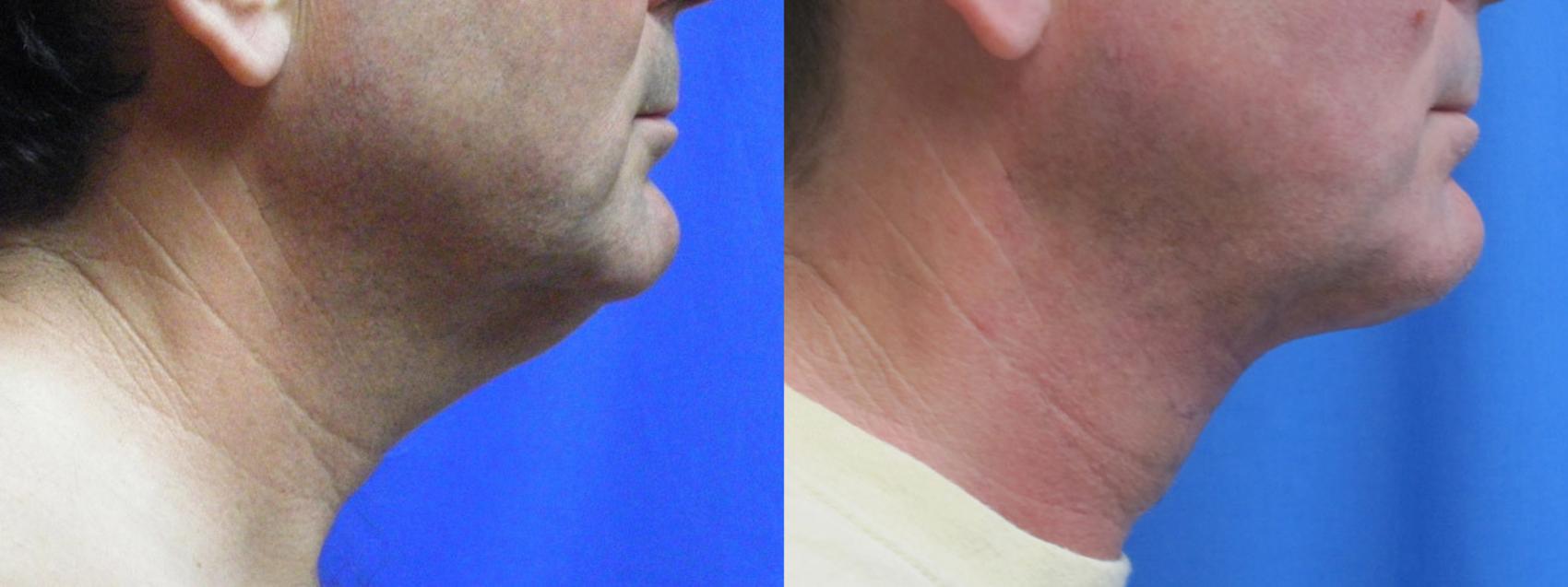 Before & After Liposuction - Neck / Precision TX Face & Neck Case 9 View #1 View in Coeur d'Alene, ID