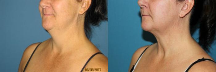 Before & After Liposuction - Neck / Precision TX Face & Neck Case 97 View #1 View in Coeur d'Alene, ID