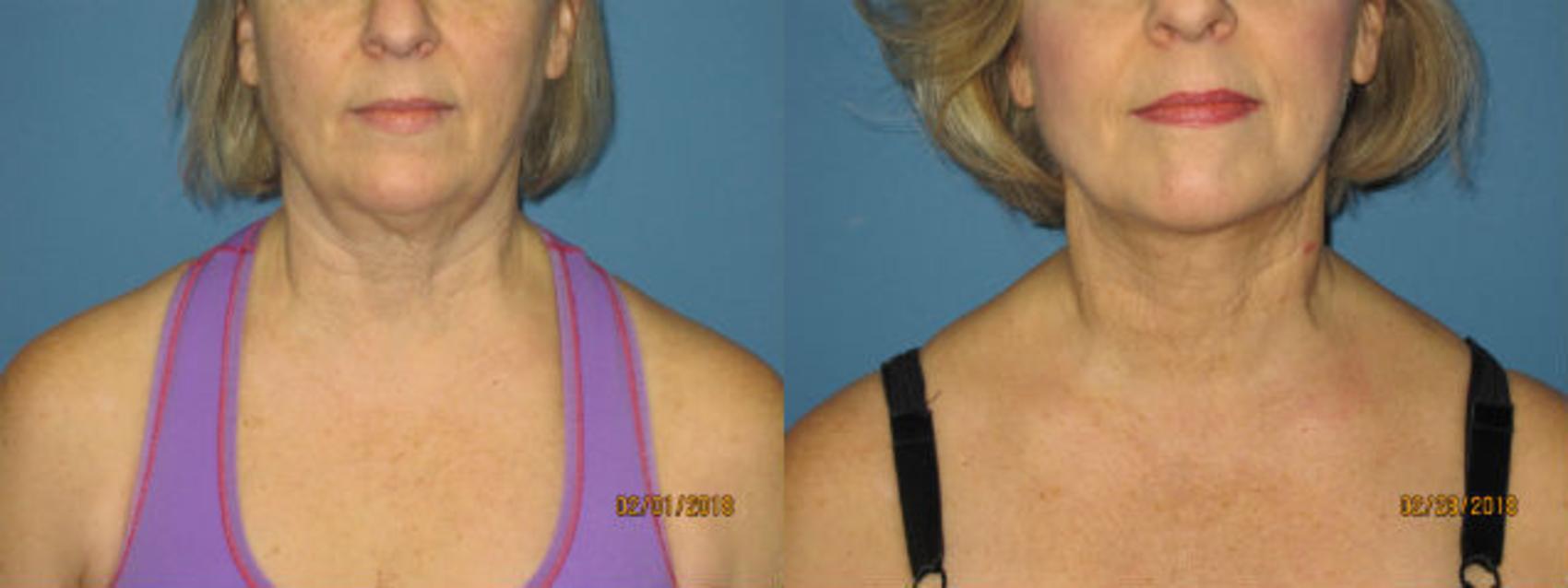 Before & After Liposuction - Neck / Precision TX Face & Neck Case 98 View #1 View in Coeur d'Alene, ID