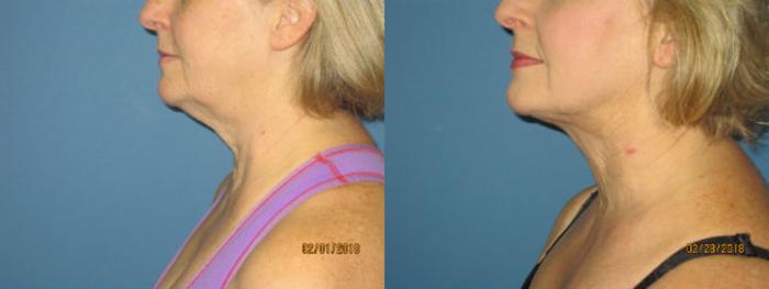 Before & After Liposuction - Neck / Precision TX Face & Neck Case 98 View #2 View in Coeur d'Alene, ID
