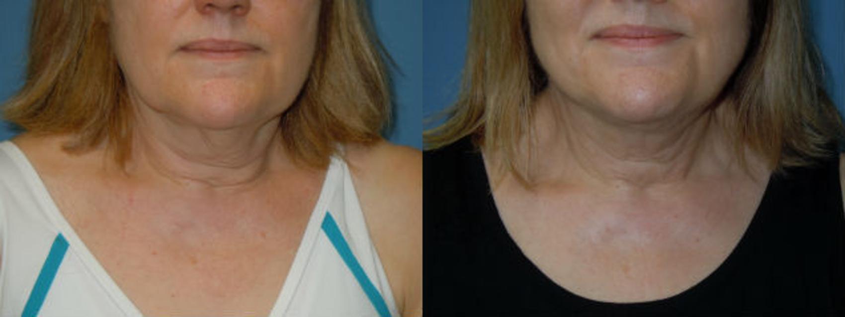 Before & After Liposuction - Neck / Precision TX Face & Neck Case 99 View #1 View in Coeur d'Alene, ID