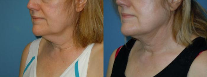 Before & After Liposuction - Neck / Precision TX Face & Neck Case 99 View #2 View in Coeur d'Alene, ID