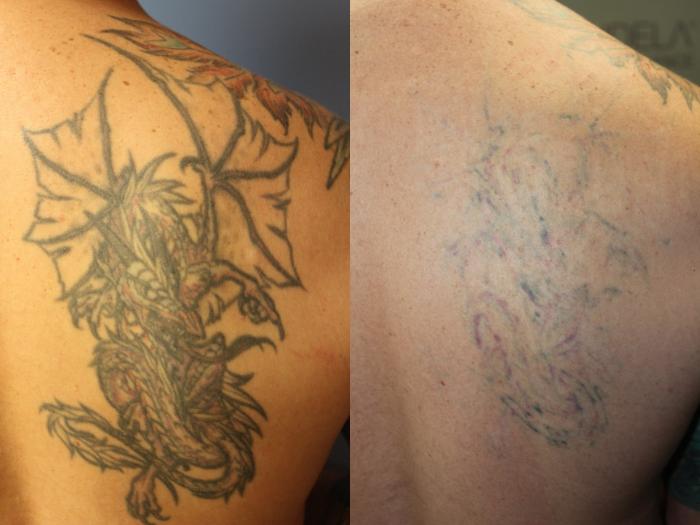 Progress of 2 completed PicoWay laser tattoo removal sessions. 