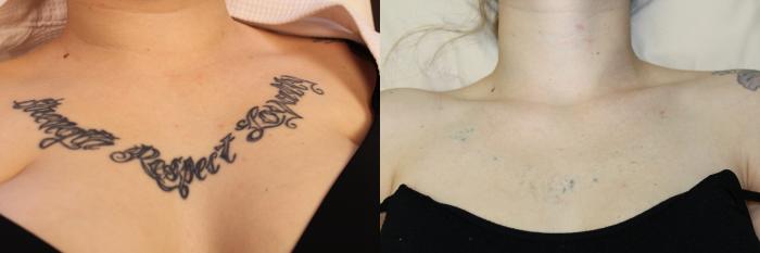 Before & After Picosecond Laser Tattoo Removal Case 204 Front View in Coeur d'Alene, ID