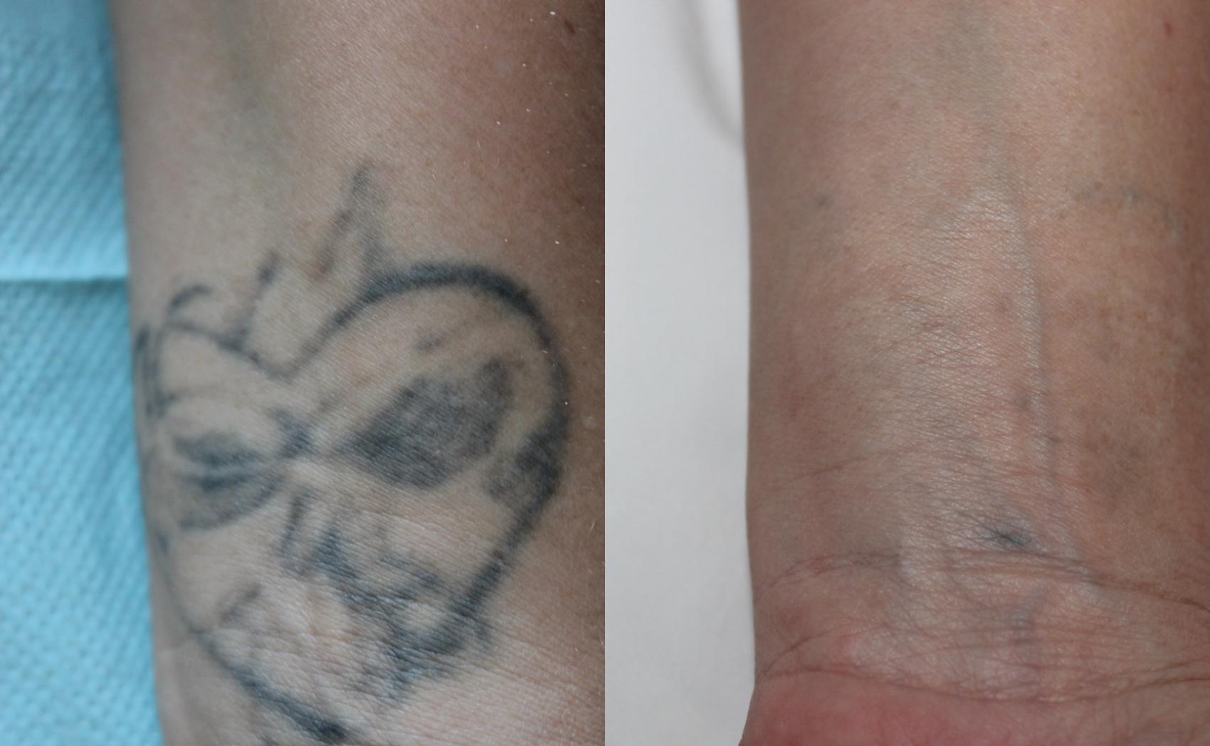 Before & After Picosecond Laser Tattoo Removal Case 207 Front View in Coeur d'Alene, ID