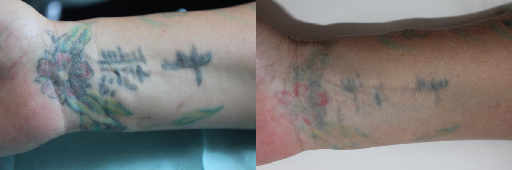 Before & After Picosecond Laser Tattoo Removal Case 208 Front View in Coeur d'Alene, ID