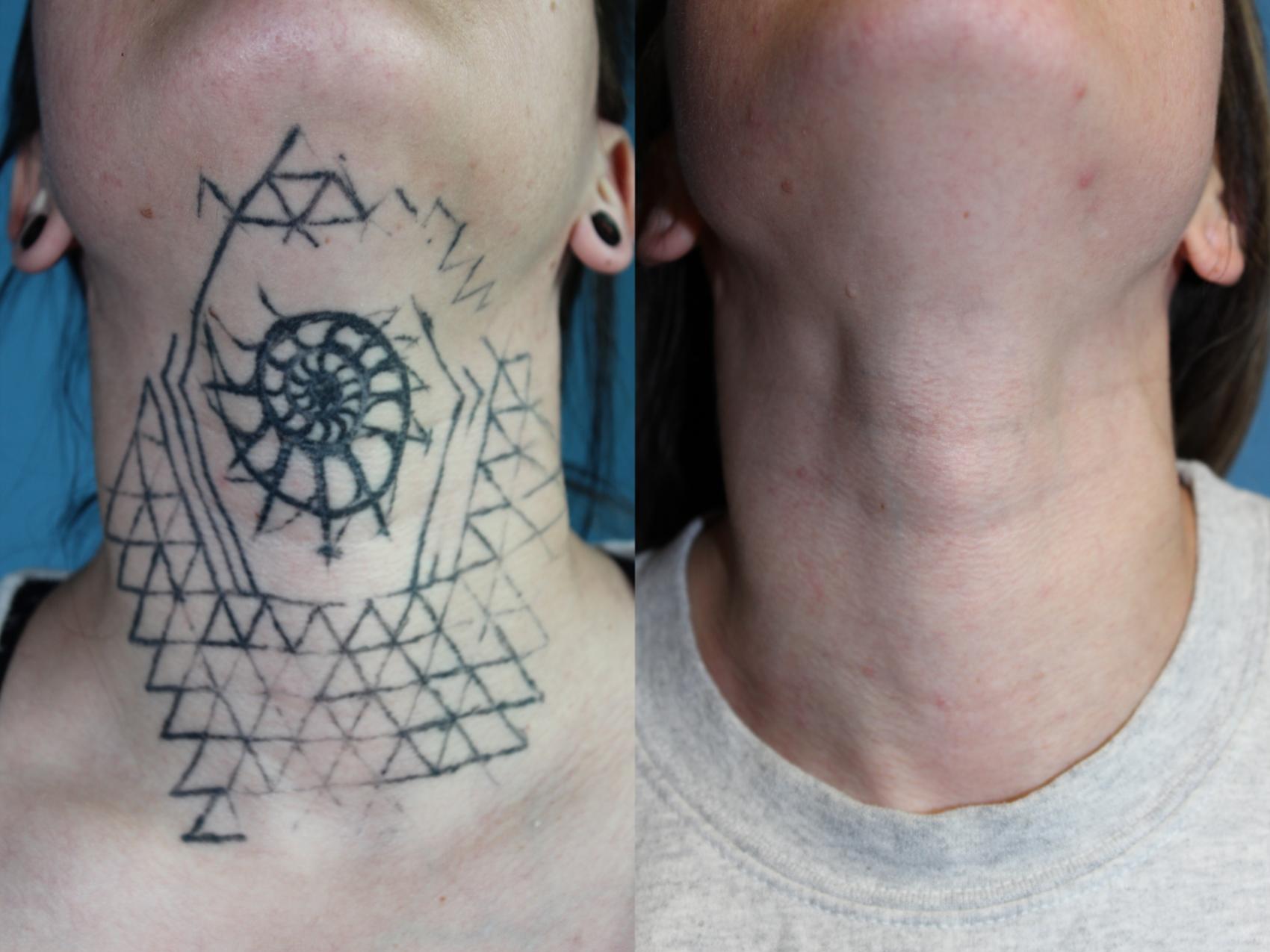Before & After Picosecond Laser Tattoo Removal Case 215 Front View in Coeur d'Alene, ID