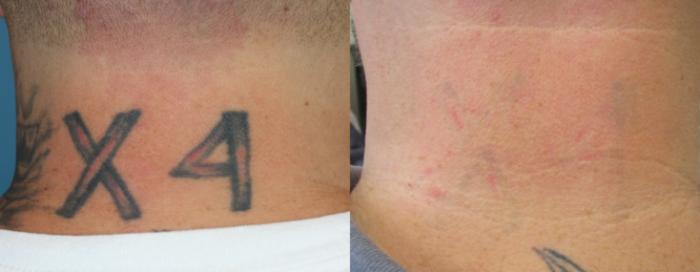 Before & After Picosecond Laser Tattoo Removal Case 219 Back View in Coeur d'Alene, ID