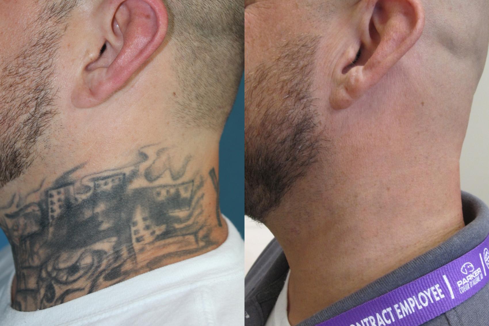 Before & After Picosecond Laser Tattoo Removal Case 219 Left Side View in Coeur d'Alene, ID