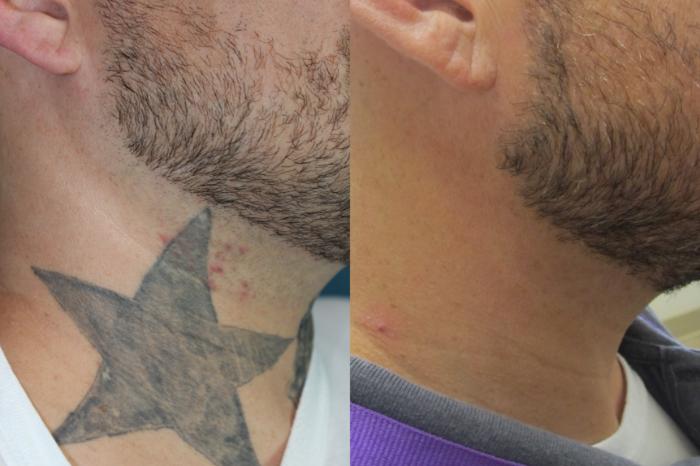 Before & After Picosecond Laser Tattoo Removal Case 219 Right Side View in Coeur d'Alene, ID