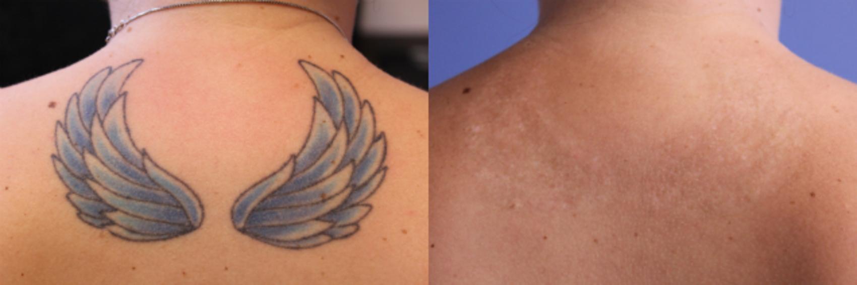 Picosecond Laser Tattoo Removal Before and After Pictures Case 73 | Coeur  d'Alene, ID | Dr. Kevin Johnson's Advanced Aesthetics