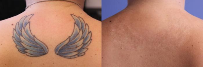Before & After Picosecond Laser Tattoo Removal Case 73 View #1 View in Coeur d'Alene, ID