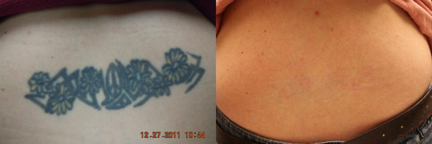 Before & After Picosecond Laser Tattoo Removal Case 74 View #1 View in Coeur d'Alene, ID