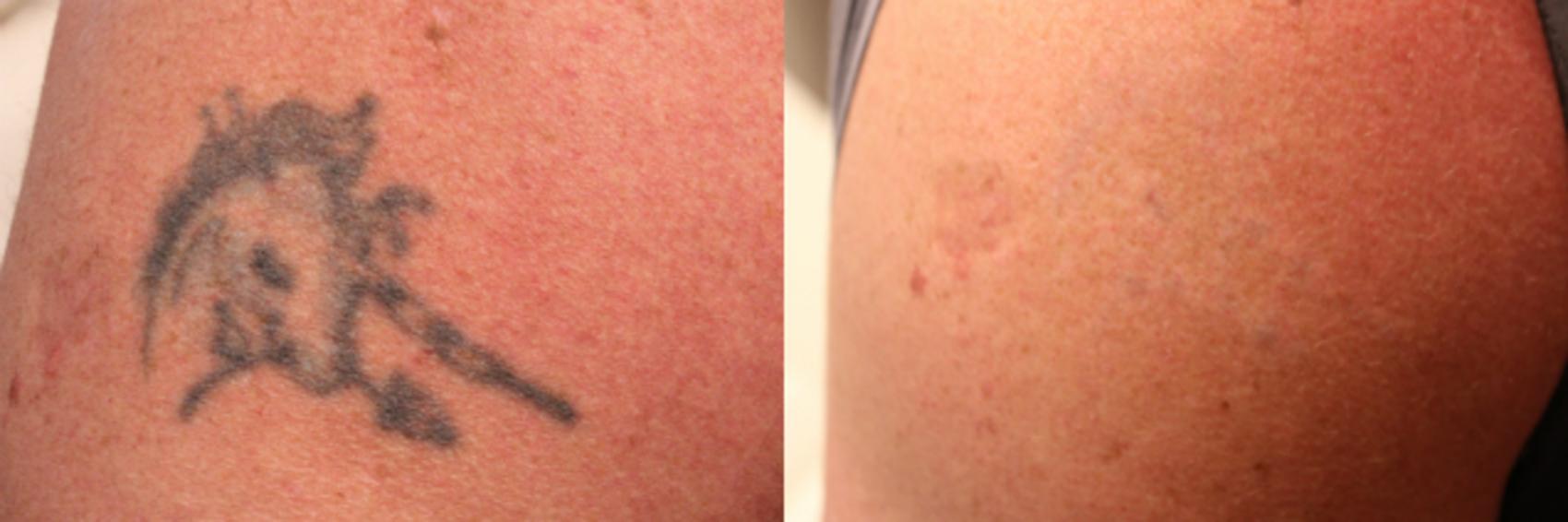Before & After Picosecond Laser Tattoo Removal Case 75 View #1 View in Coeur d'Alene, ID