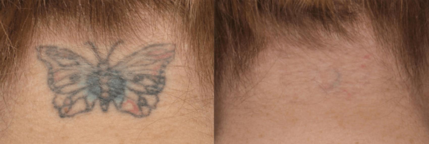Tattoo Removal  Premier Body and Laser