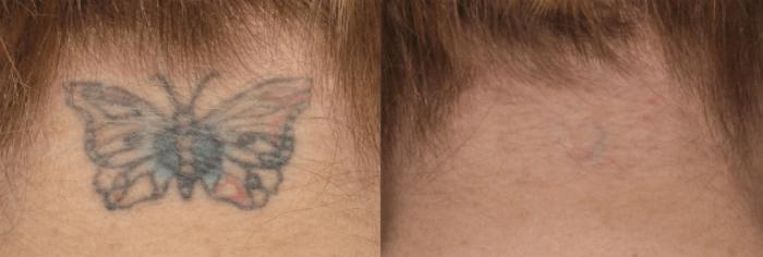 Before & After Picosecond Laser Tattoo Removal Case 80 View #1 View in Coeur d'Alene, ID