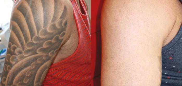 Before & After Picosecond Laser Tattoo Removal Case 81 View #1 View in Coeur d'Alene, ID