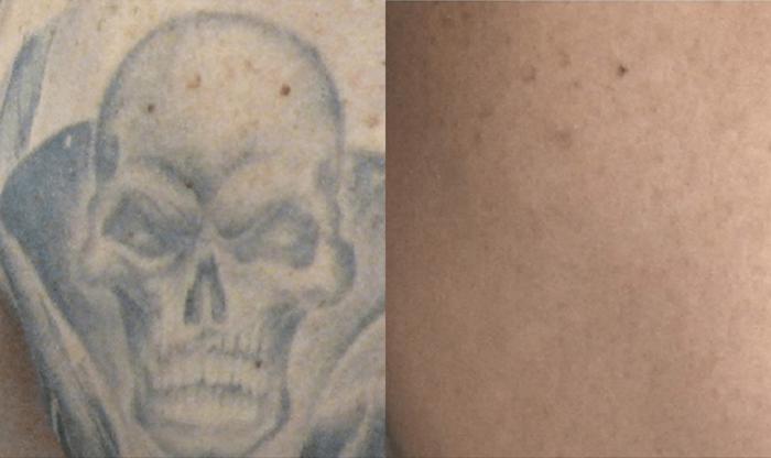 Before & After Picosecond Laser Tattoo Removal Case 82 View #1 View in Coeur d'Alene, ID