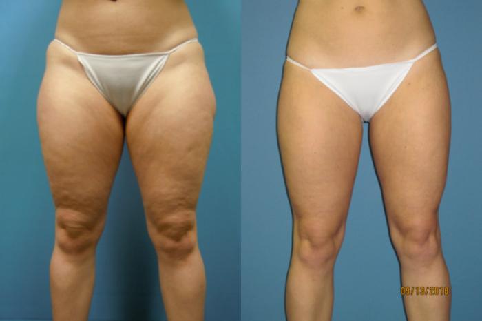 Before & After Liposuction - Inner and/or Outer Thighs Case 113 View #1 View in Coeur d'Alene, ID