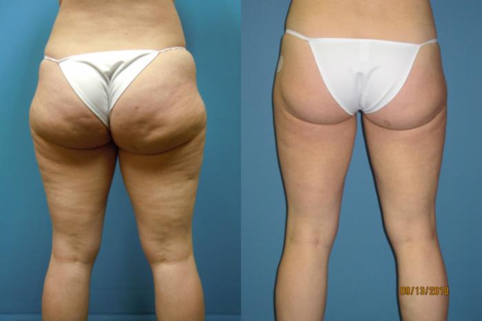 Before & After Liposuction - Inner and/or Outer Thighs Case 113 View #2 View in Coeur d'Alene, ID