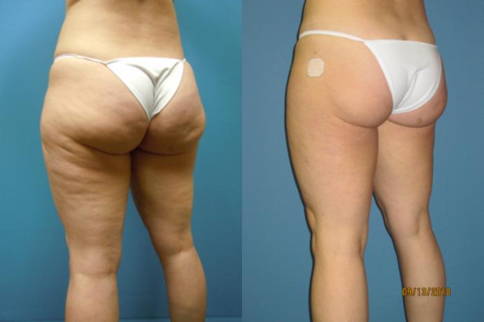 Before & After Liposuction - Inner and/or Outer Thighs Case 113 View #3 View in Coeur d'Alene, ID
