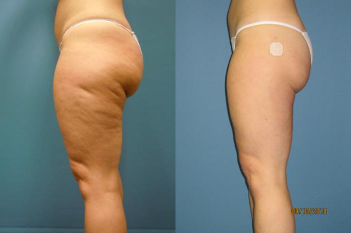 Before & After Liposuction - Inner and/or Outer Thighs Case 113 View #4 View in Coeur d'Alene, ID