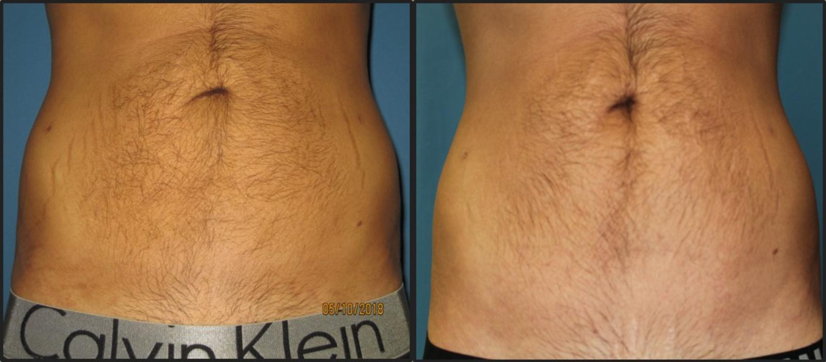 Before & After Profound™ Radio Frequency Microneedling Case 114 View #1 View in Coeur d'Alene, ID