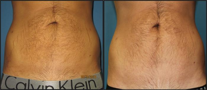 Before & After Liposuction - Abdomen / Flanks Case 114 View #1 View in Coeur d'Alene, ID