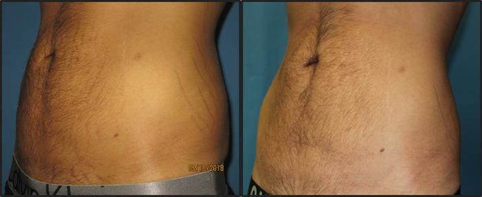 Before & After Liposuction - Abdomen / Flanks Case 114 View #2 View in Coeur d'Alene, ID