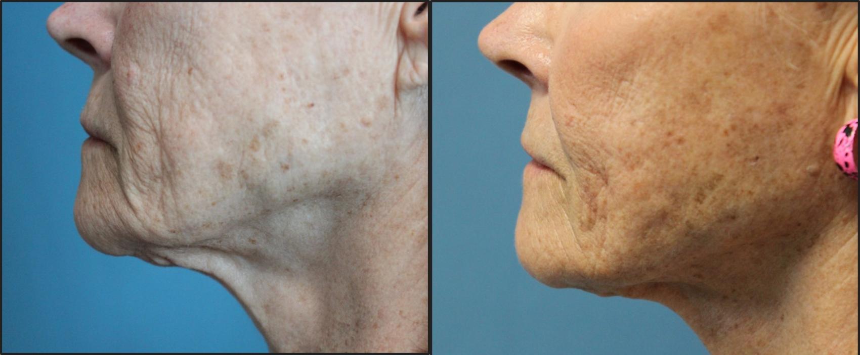 Before & After Profound™ Radio Frequency Microneedling Case 115 View #1 View in Coeur d'Alene, ID