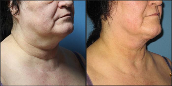 Before & After Liposuction - Neck / Precision TX Face & Neck Case 116 View #1 View in Coeur d'Alene, ID