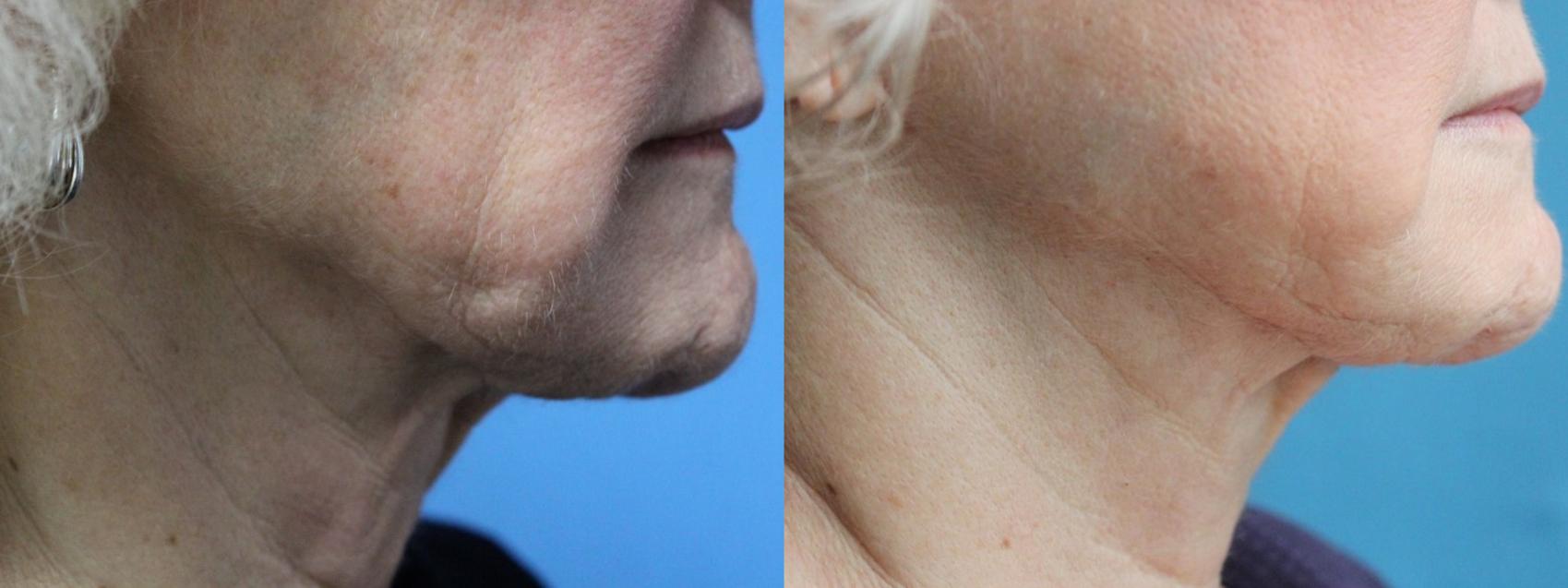 Before & After Profound™ Radio Frequency Microneedling Case 118 View #1 View in Coeur d'Alene, ID