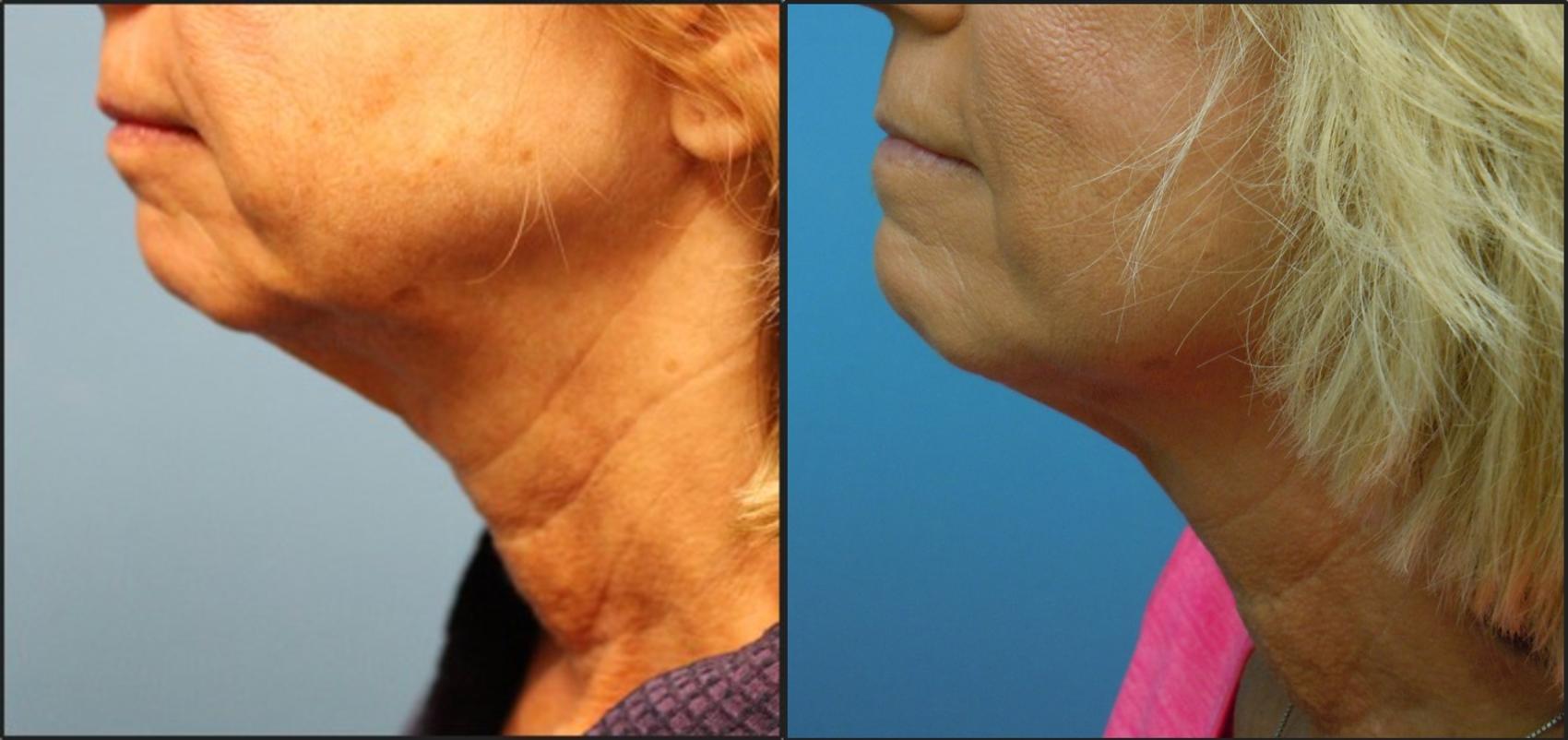 Before & After Profound™ Radio Frequency Microneedling Case 119 View #1 View in Coeur d'Alene, ID