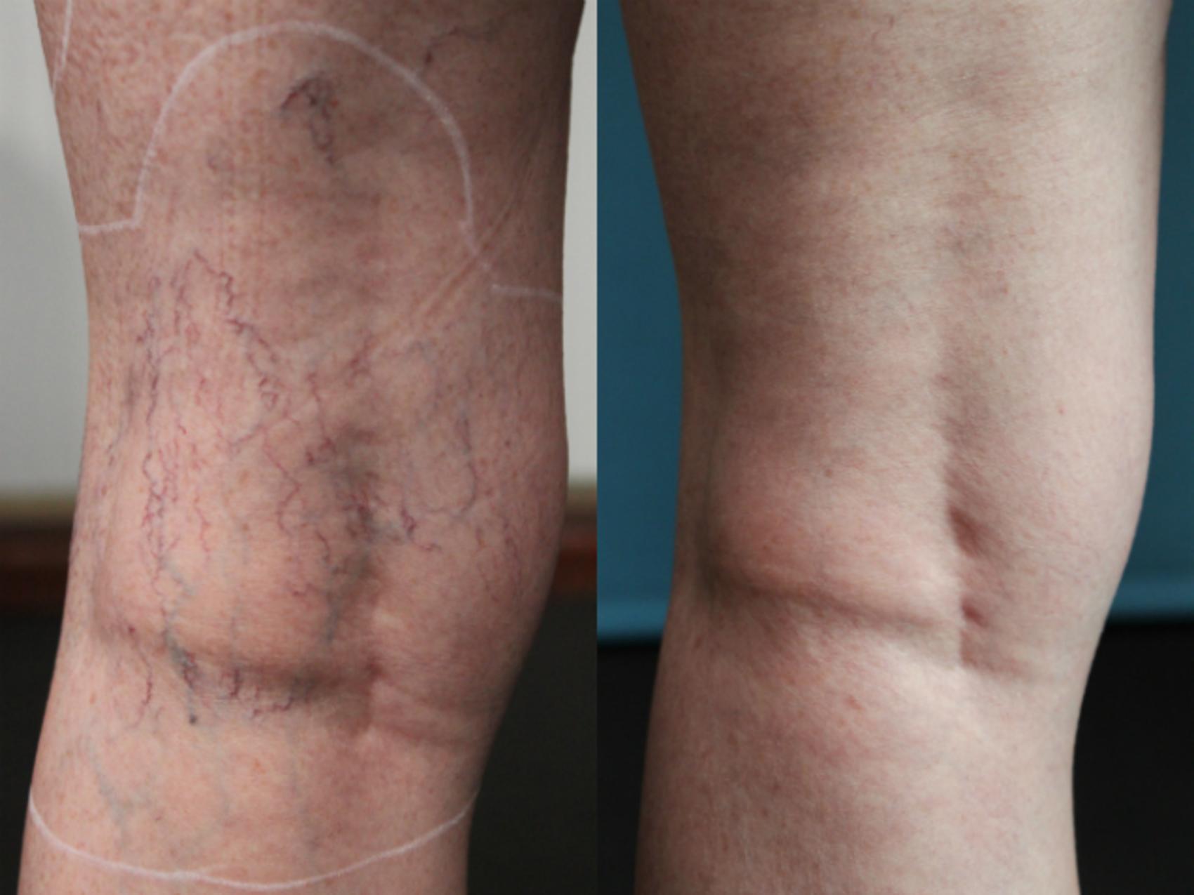 Laser Vein Removal - Discovery Laser Skin Care Clinic