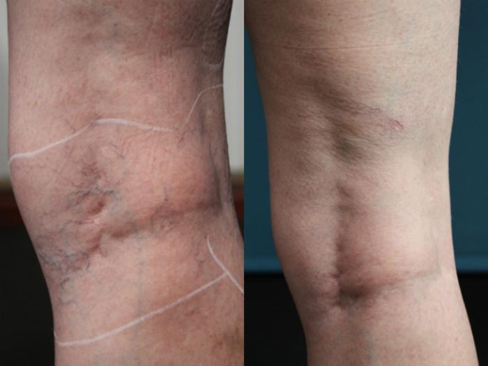 Before & After Vein Treatments Case 83 View #2 View in Coeur d'Alene, ID